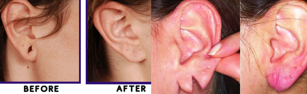 Ear Lobe Repair