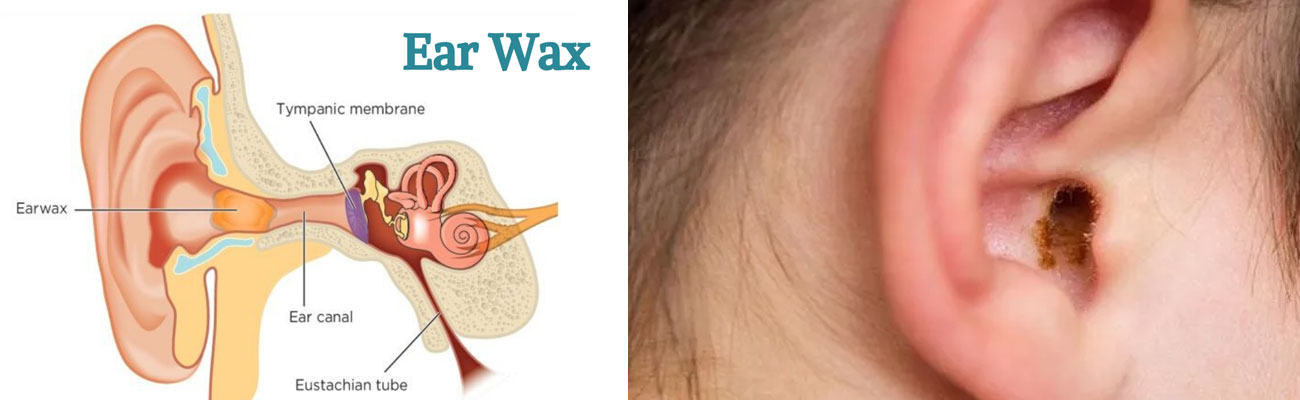 Ear Wax Cleaning