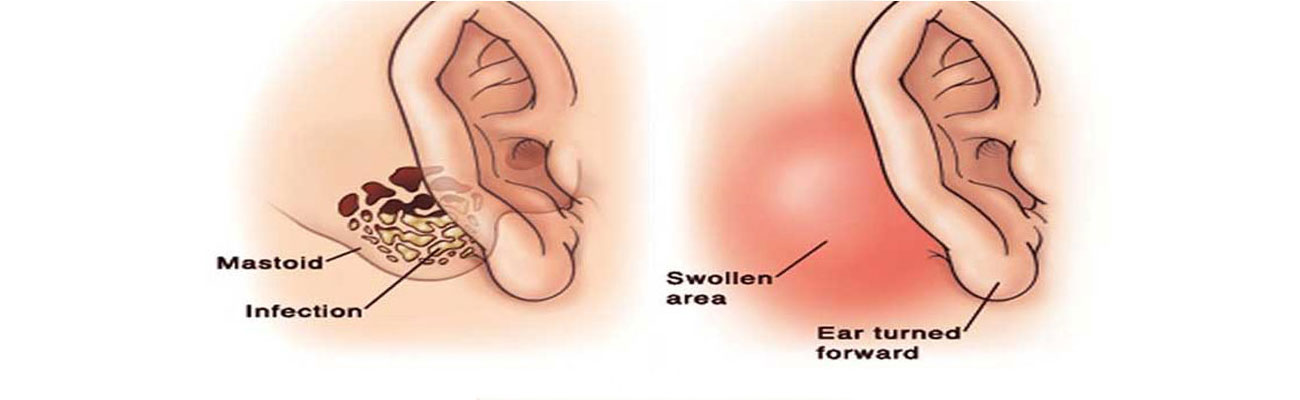 Mastoidectomy