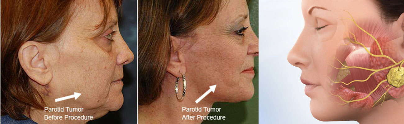 Microscopic Parotid surgery
